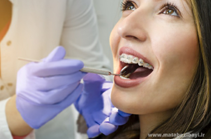 لق شدن دندان در ارتودنسی