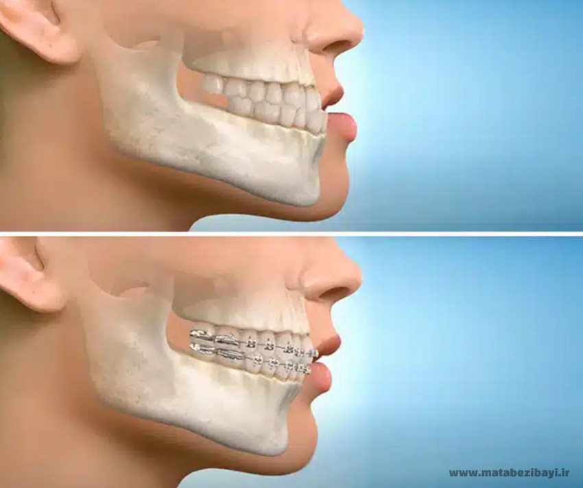 تاثیر ارتودنسی بر چهره