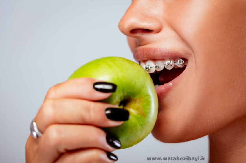 شکستن براکت ارتودنسی