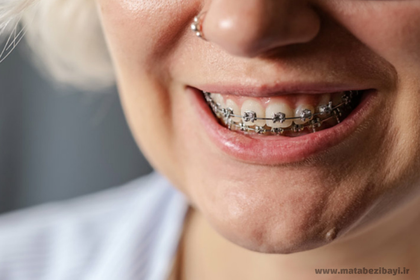 ارتودنسی بزرگسالان