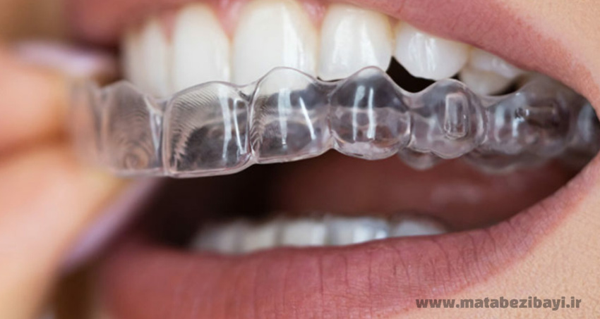 ارتودنسی نامرئی چیست