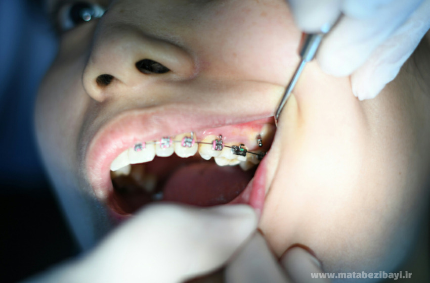 ارتودنسی دندان نهفته