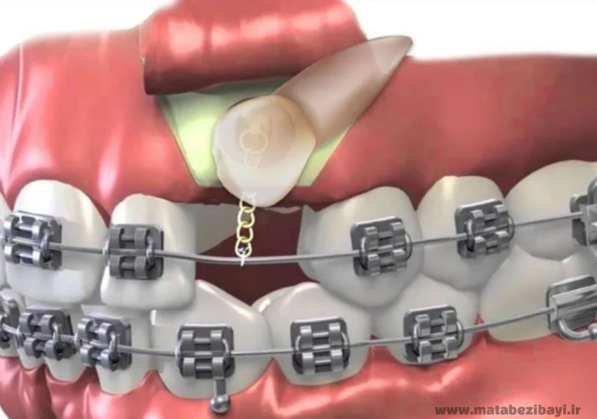 ارتودنسی دندان نهفته