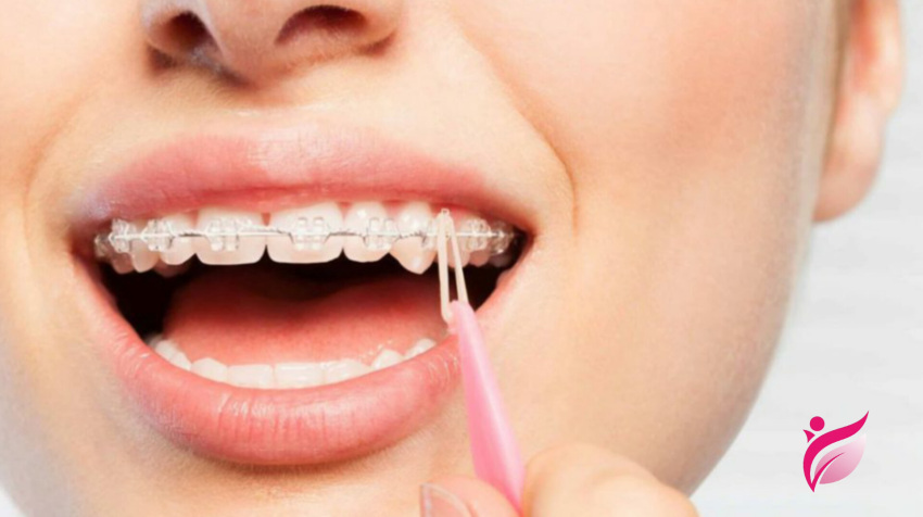 دلایل پاره شدن کش ارتودنسی