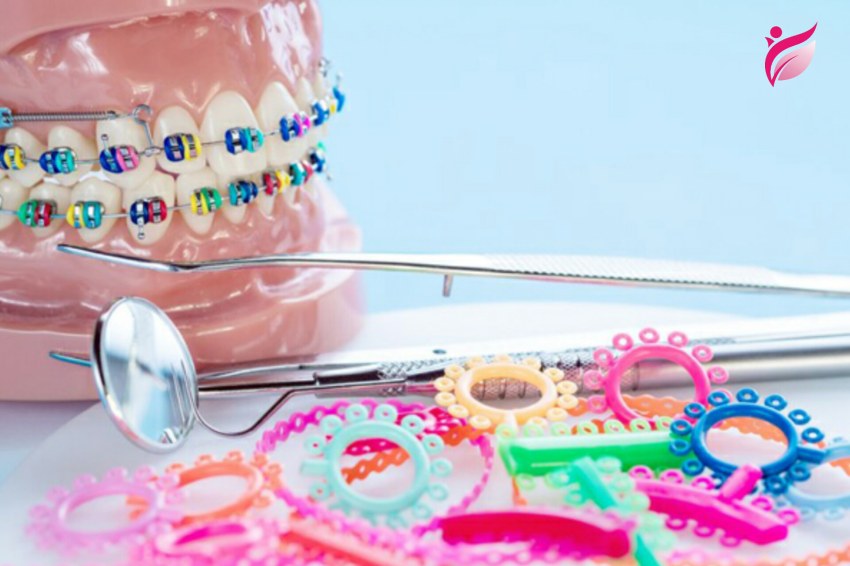 دلایل پاره شدن کش ارتودنسی