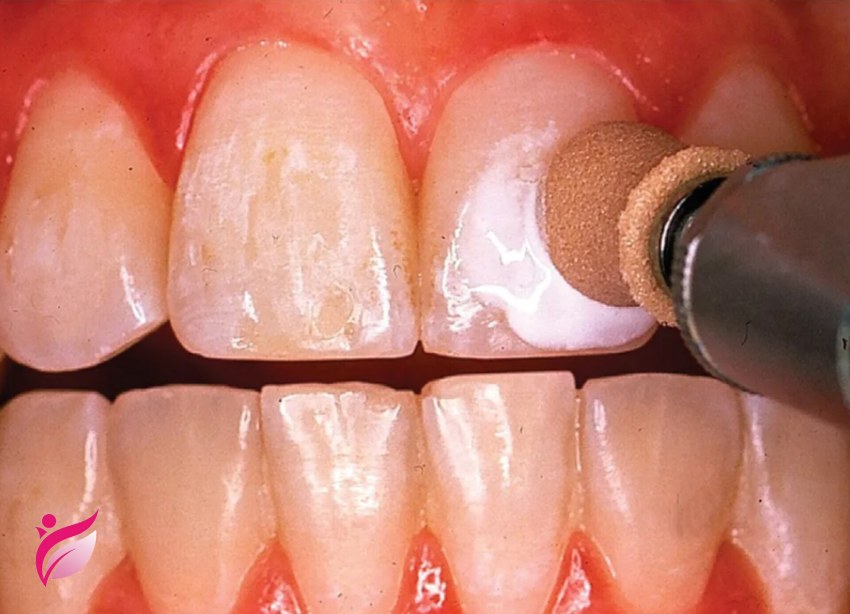 برداشتن براکت ارتودنسی