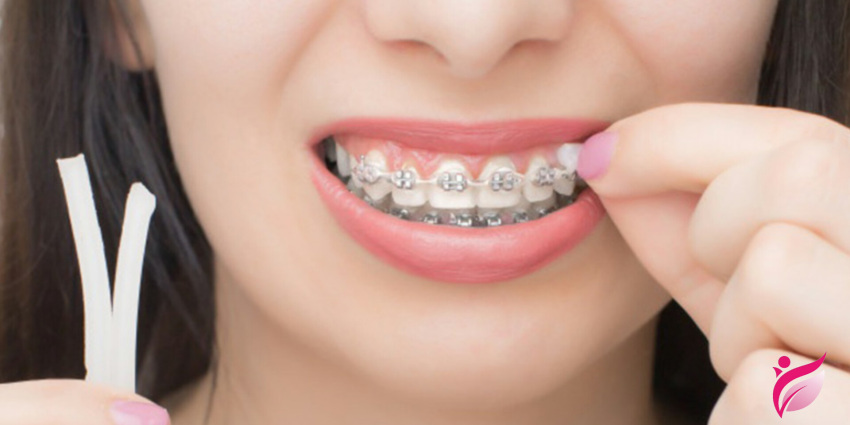 موم ارتودنسی چیست؟