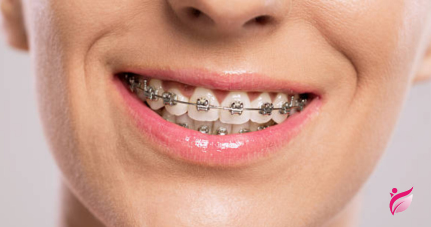 ارتودنسی ثابت