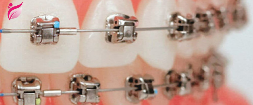 ارتودنسی دیمون