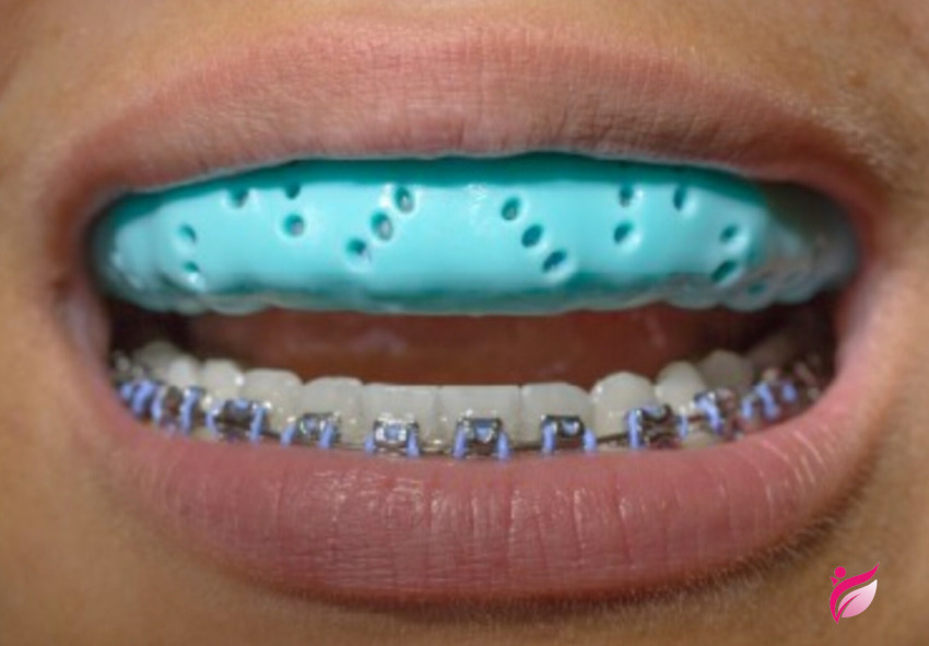 ورزش با ارتودنسی