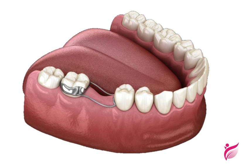 فضا نگهدار ارتودنسی چیست؟