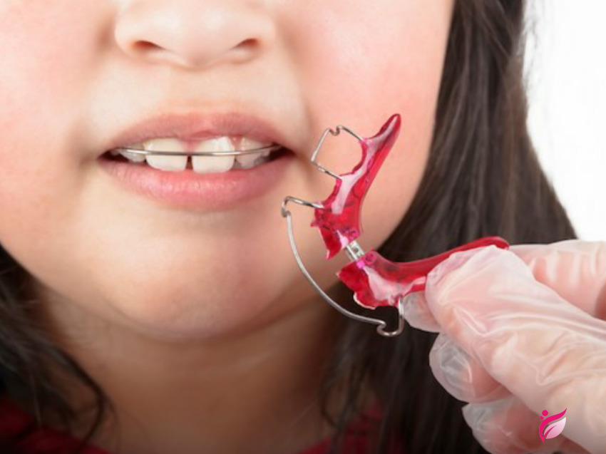 فضا نگهدار ارتودنسی چیست؟