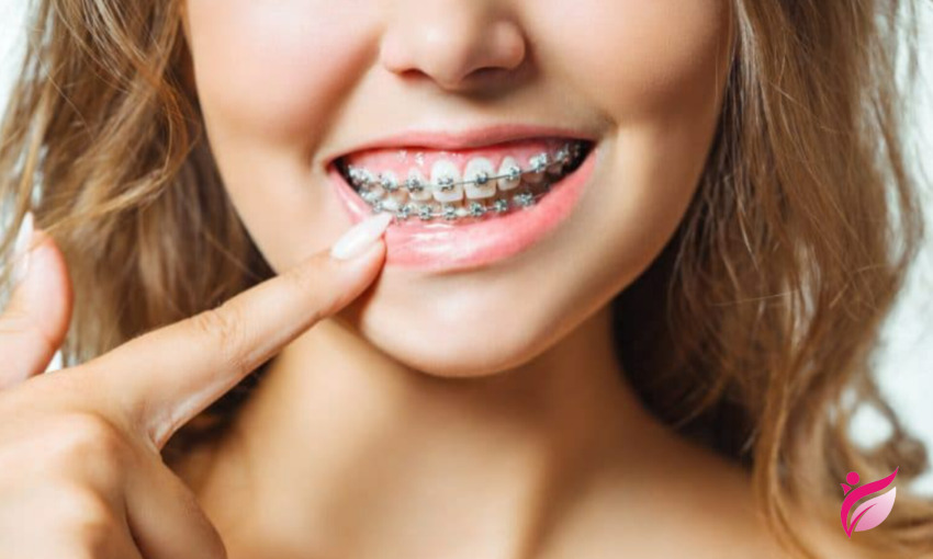 عملکرد براکت ها در ارتودنسی
