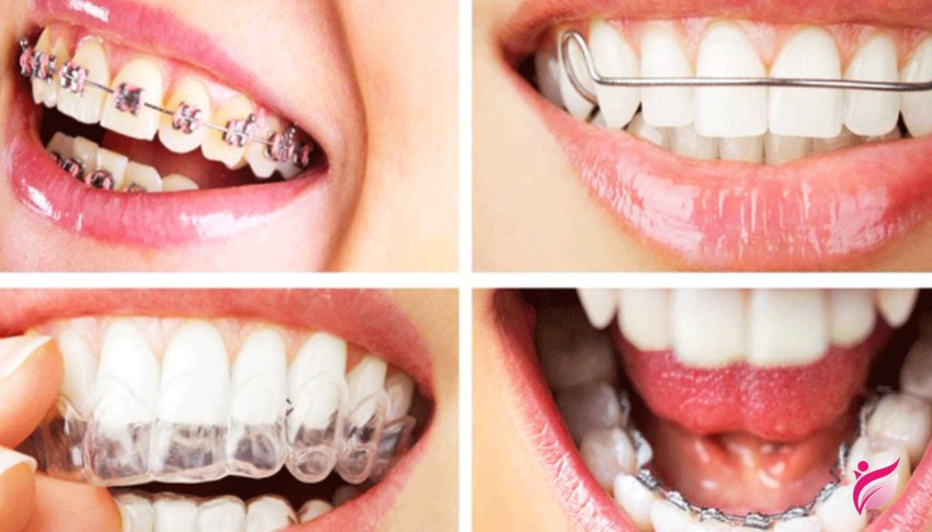 عملکرد براکت ها در ارتودنسی