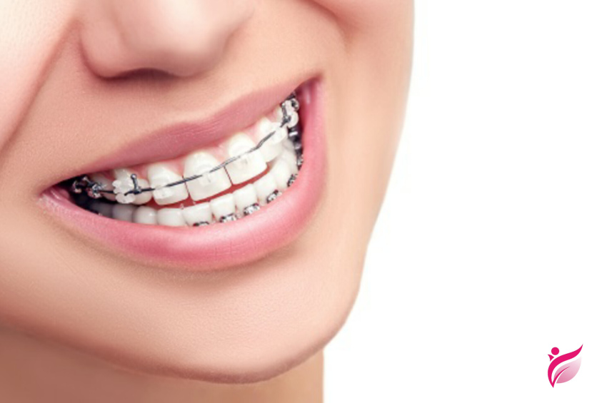 ارتودنسی فانکشنال