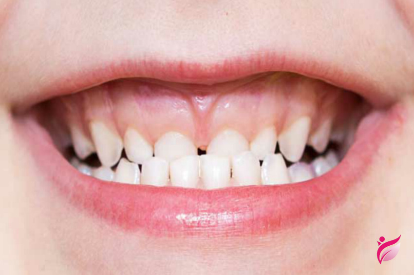 ارتودنسی فانکشنال