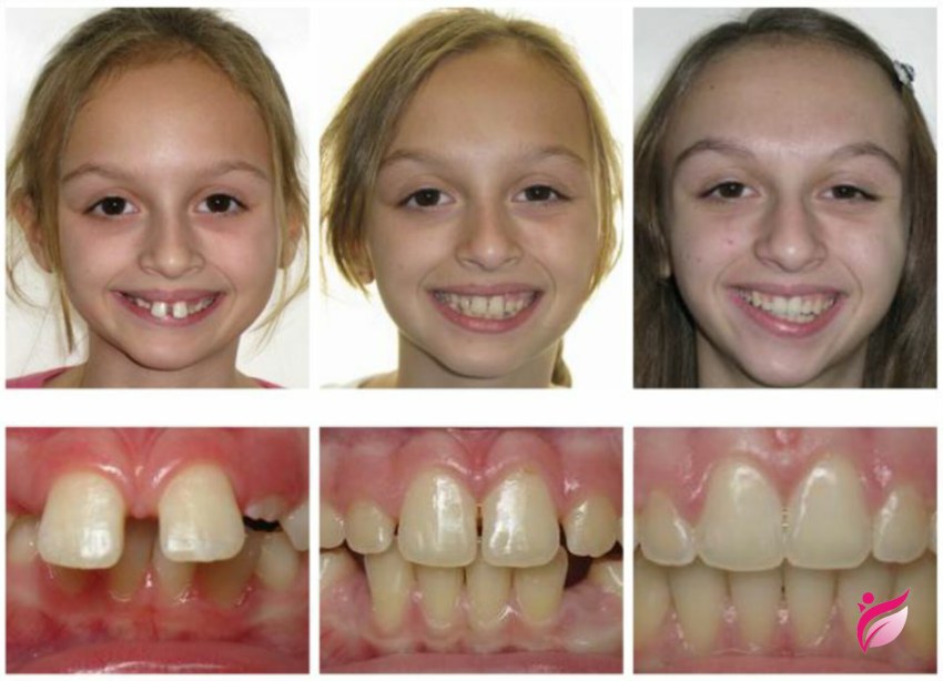 ارتودنسی دو مرحله ای