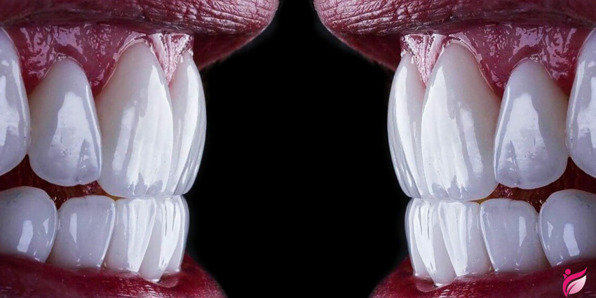 کامپوزیت یا لمینت