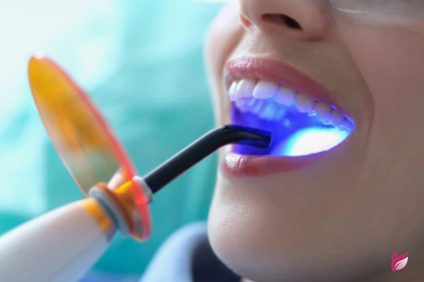 مراحل کامپوزیت دندان