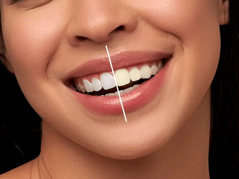 بلیچینگ بهتره یا کامپوزیت