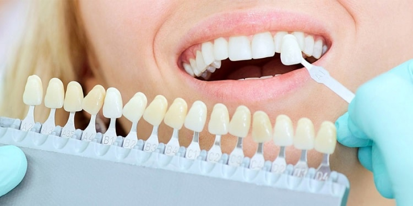 طبیعی ترین رنگ کامپوزیت دندان