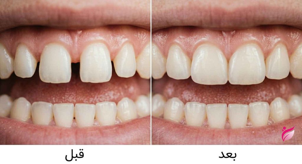 کامپوزیت برای دندانهای فاصله دار