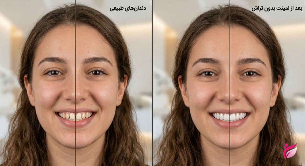 لمینت بدون تراش دندان