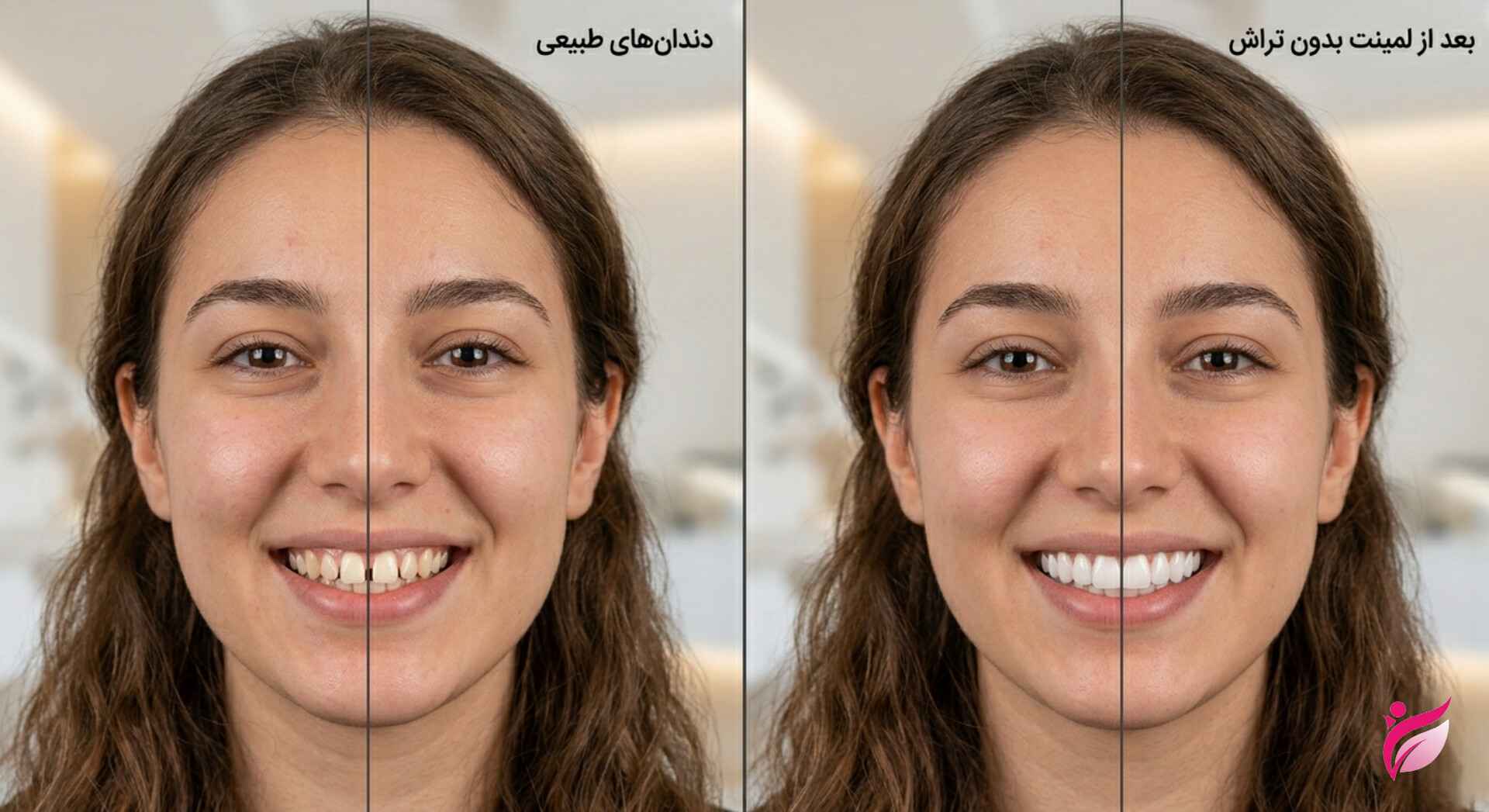 لمینت بدون تراش دندان