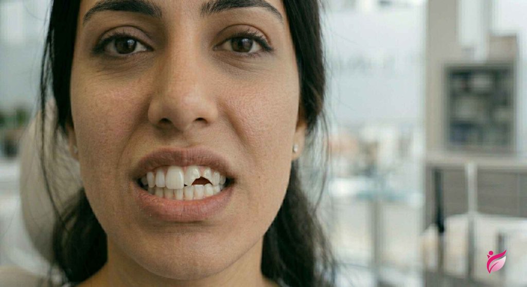 لب پر شدن لمینت دندان