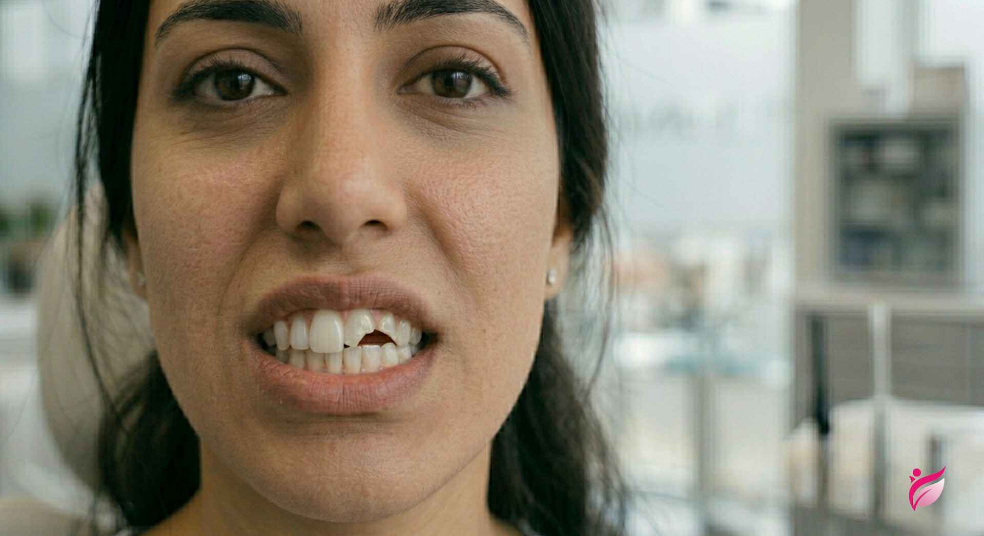 لب پر شدن لمینت دندان